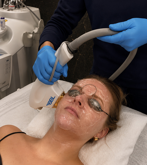 Jenny using the BBL Laser