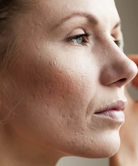 Acne Scars
