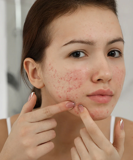 Active Acne