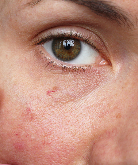 Broken Capillaries & Facial Veins