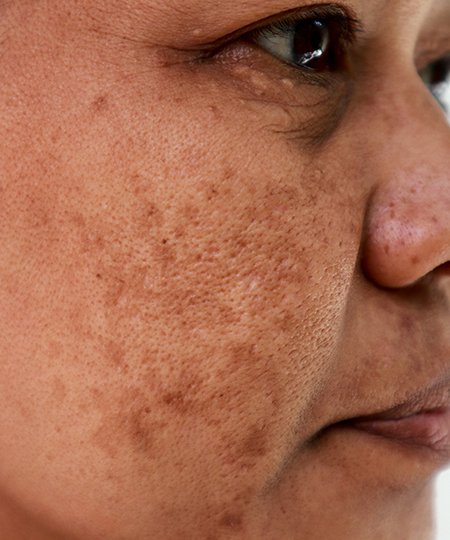 Melasma Skin Condition