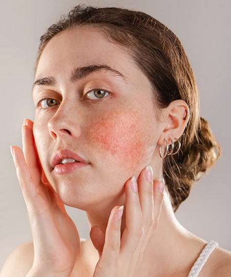 Rosacea and Facial Redness
