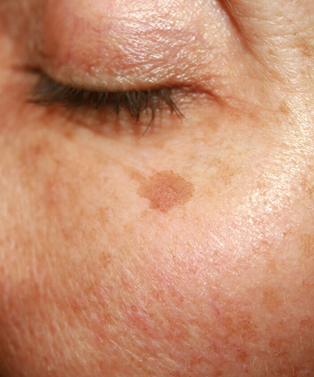 Sun Damage Skin Condition