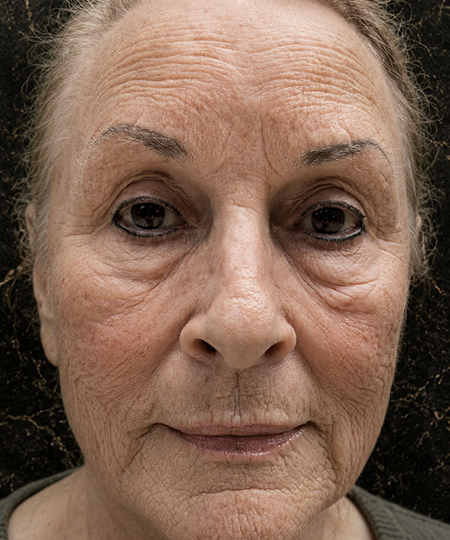 Wrinkles